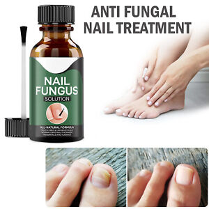 Nail Fungus 2 Nail Fungus 2