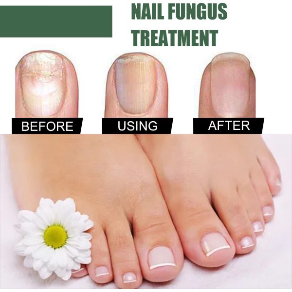 Foot Cure Nail Fungus Treatment - Image 6
