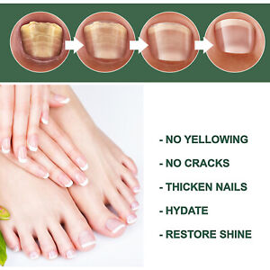 Foot Cure Nail Fungus Treatment - Image 7
